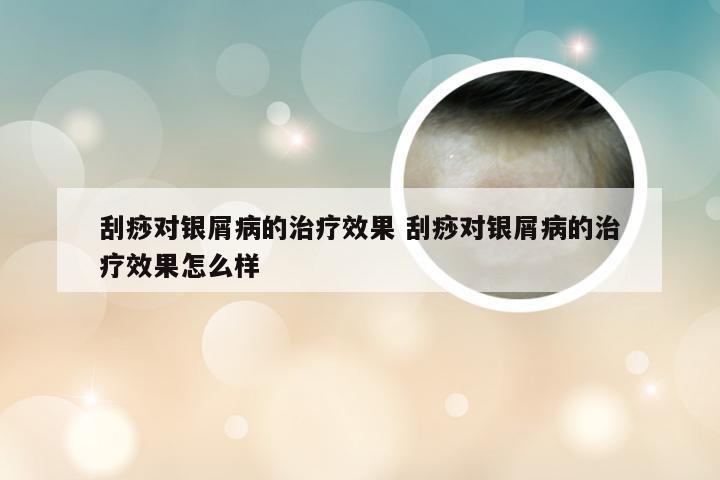 刮痧对银屑病的治疗效果 刮痧对银屑病的治疗效果怎么样