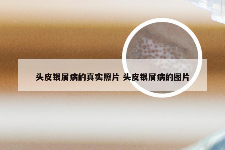头皮银屑病的真实照片 头皮银屑病的图片