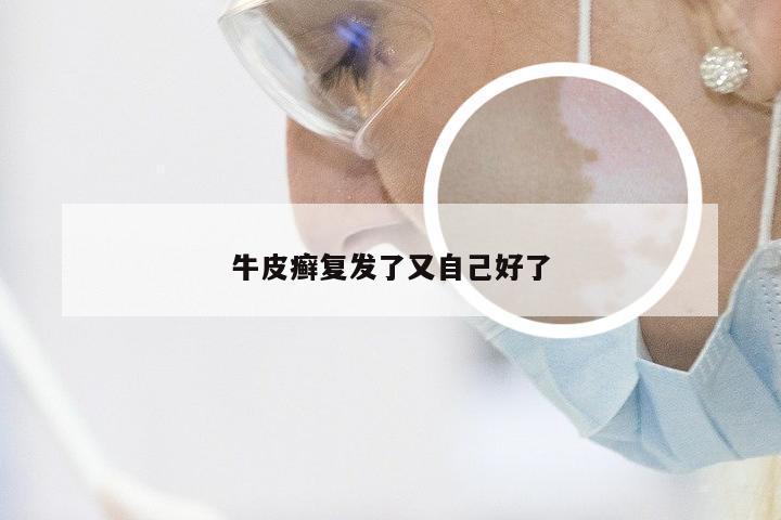牛皮癣复发了又自己好了