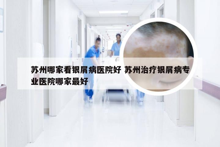 苏州哪家看银屑病医院好 苏州治疗银屑病专业医院哪家最好