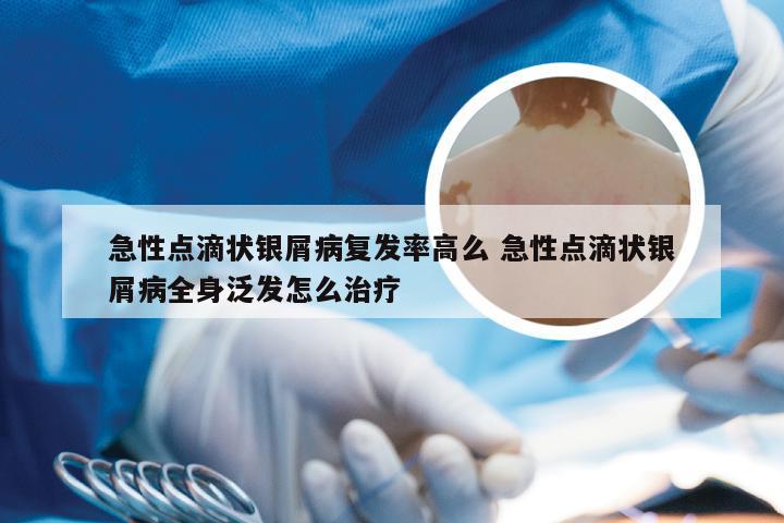 急性点滴状银屑病复发率高么 急性点滴状银屑病全身泛发怎么治疗