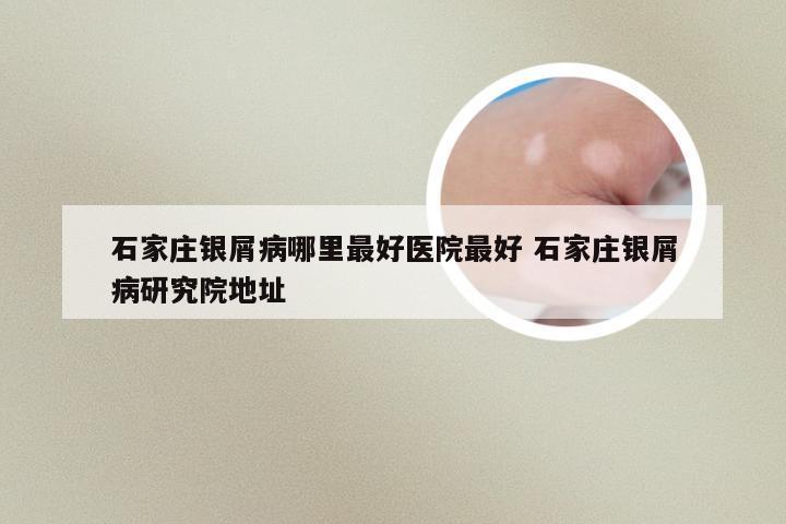 石家庄银屑病哪里最好医院最好 石家庄银屑病研究院地址
