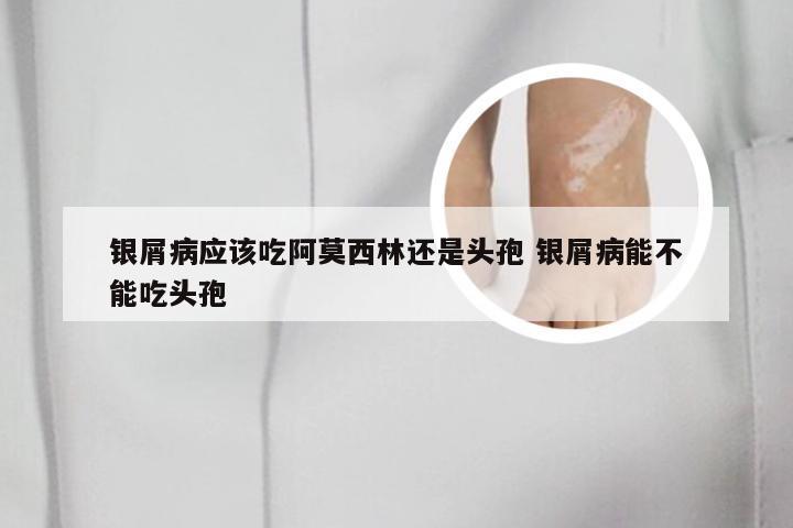 银屑病应该吃阿莫西林还是头孢 银屑病能不能吃头孢