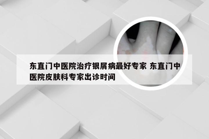 东直门中医院治疗银屑病最好专家 东直门中医院皮肤科专家出诊时间
