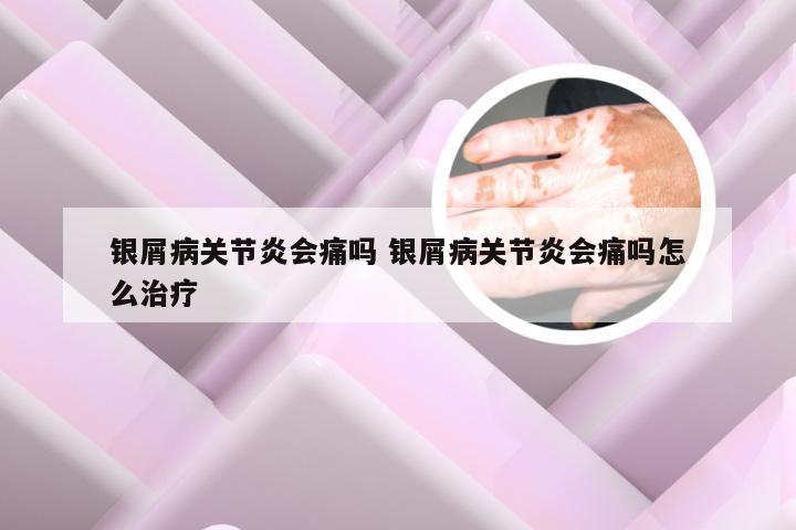 银屑病关节炎会痛吗 银屑病关节炎会痛吗怎么治疗