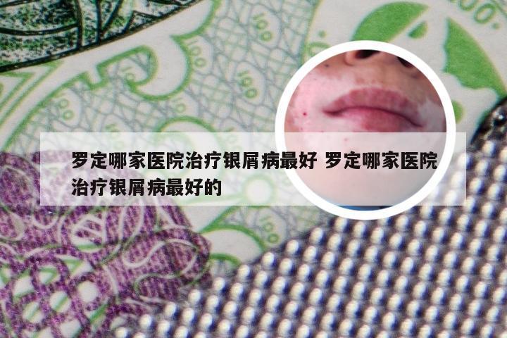 罗定哪家医院治疗银屑病最好 罗定哪家医院治疗银屑病最好的