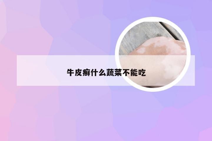 牛皮癣什么蔬菜不能吃