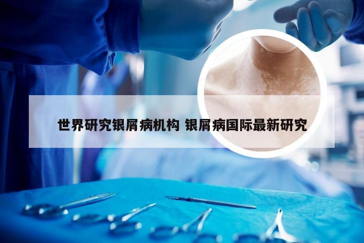 世界研究银屑病机构 银屑病国际最新研究