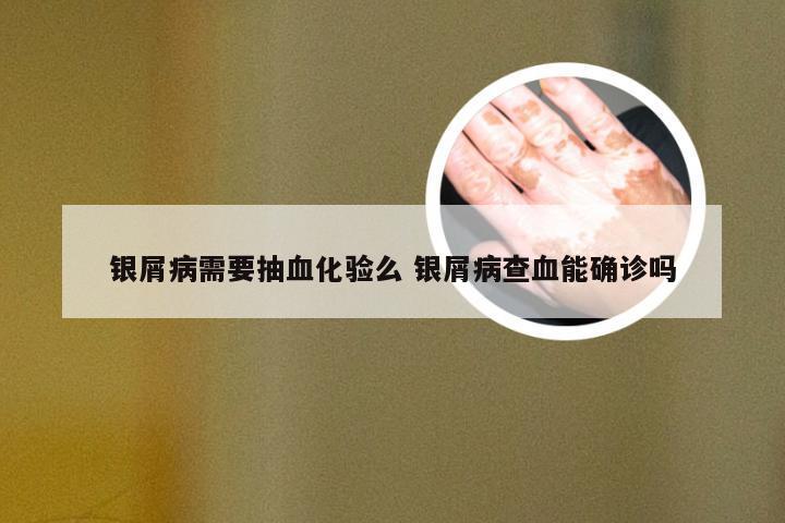 银屑病需要抽血化验么 银屑病查血能确诊吗