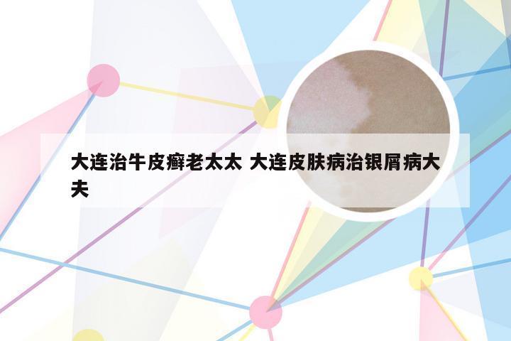 大连治牛皮癣老太太 大连皮肤病治银屑病大夫