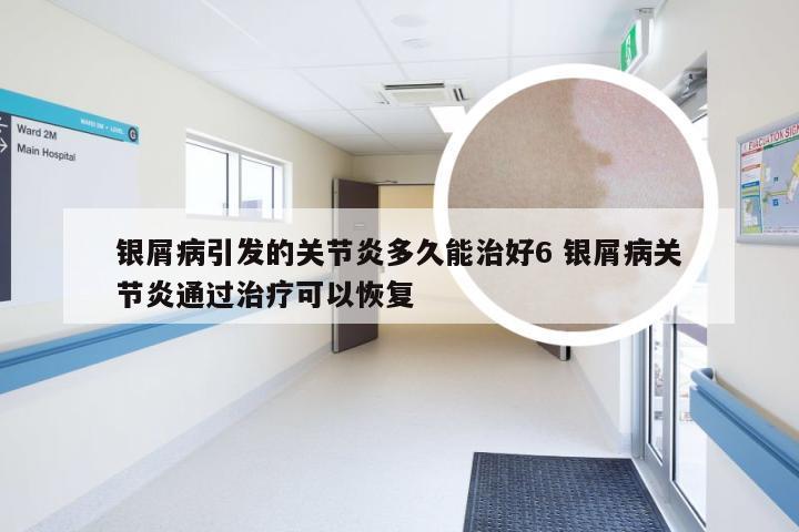 银屑病引发的关节炎多久能治好6 银屑病关节炎通过治疗可以恢复