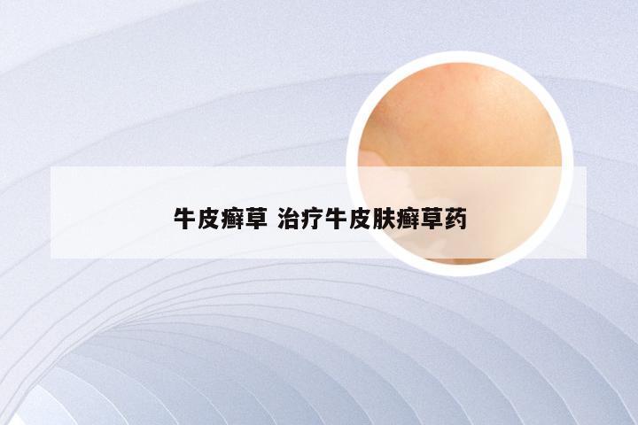 牛皮癣草 治疗牛皮肤癣草药