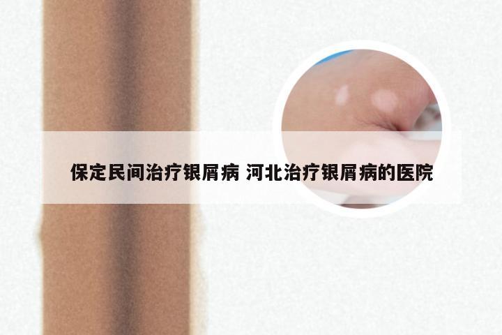 保定民间治疗银屑病 河北治疗银屑病的医院