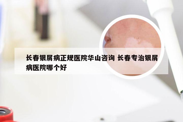 长春银屑病正规医院华山咨询 长春专治银屑病医院哪个好