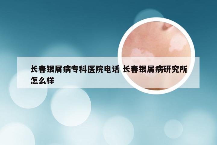 长春银屑病专科医院电话 长春银屑病研究所怎么样