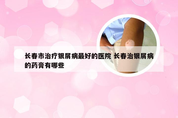 长春市治疗银屑病最好的医院 长春治银屑病的药膏有哪些