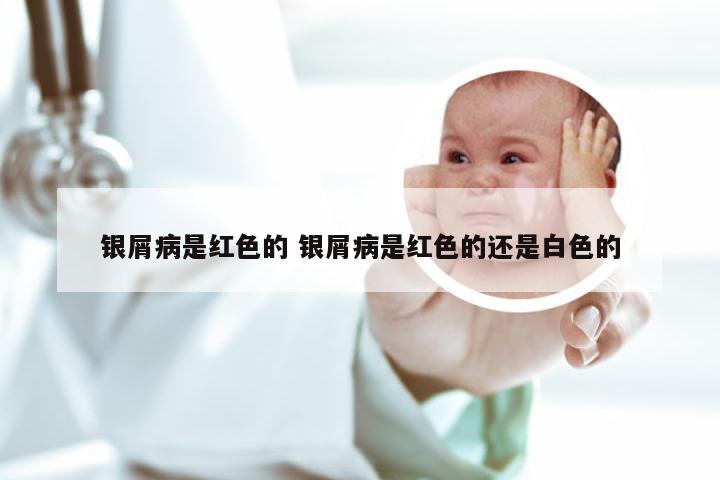 银屑病是红色的 银屑病是红色的还是白色的