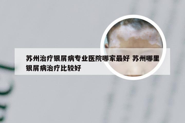 苏州治疗银屑病专业医院哪家最好 苏州哪里银屑病治疗比较好