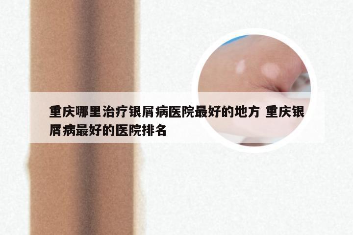重庆哪里治疗银屑病医院最好的地方 重庆银屑病最好的医院排名