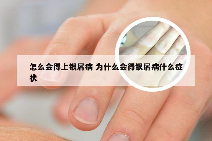 怎么会得上银屑病 为什么会得银屑病什么症状