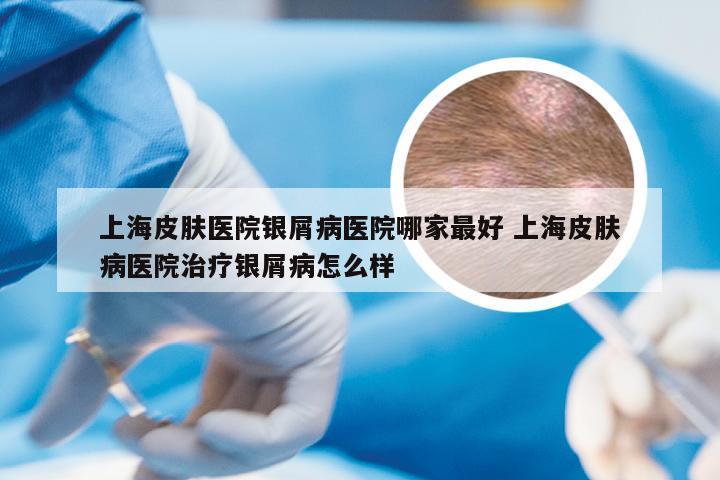 上海皮肤医院银屑病医院哪家最好 上海皮肤病医院治疗银屑病怎么样