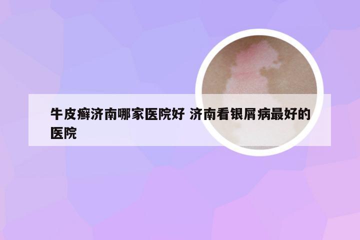 牛皮癣济南哪家医院好 济南看银屑病最好的医院