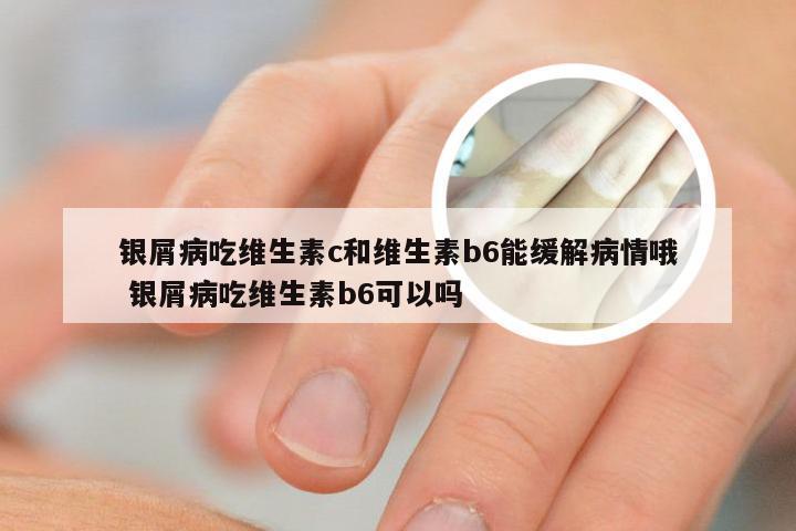 银屑病吃维生素c和维生素b6能缓解病情哦 银屑病吃维生素b6可以吗