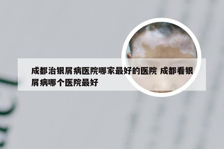 成都治银屑病医院哪家最好的医院 成都看银屑病哪个医院最好