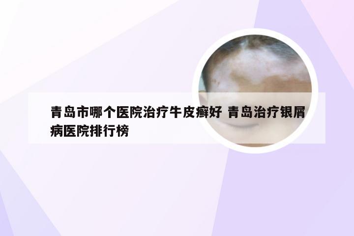 青岛市哪个医院治疗牛皮癣好 青岛治疗银屑病医院排行榜