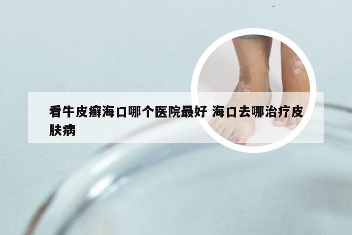 看牛皮癣海口哪个医院最好 海口去哪治疗皮肤病
