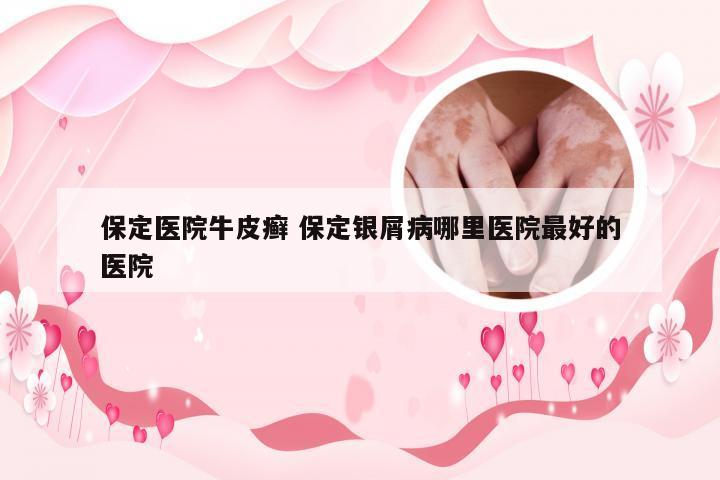 保定医院牛皮癣 保定银屑病哪里医院最好的医院