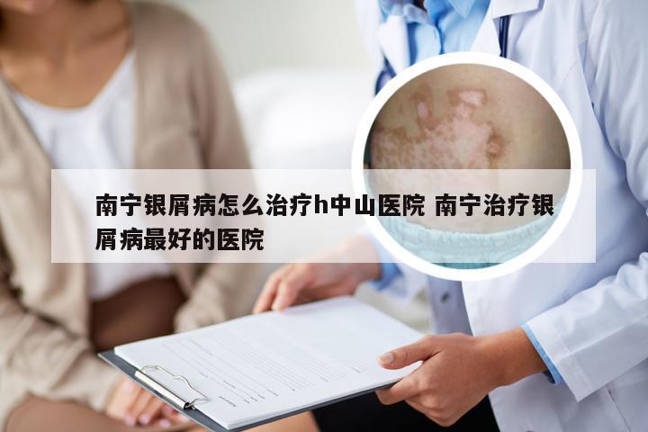 南宁银屑病怎么治疗h中山医院 南宁治疗银屑病最好的医院