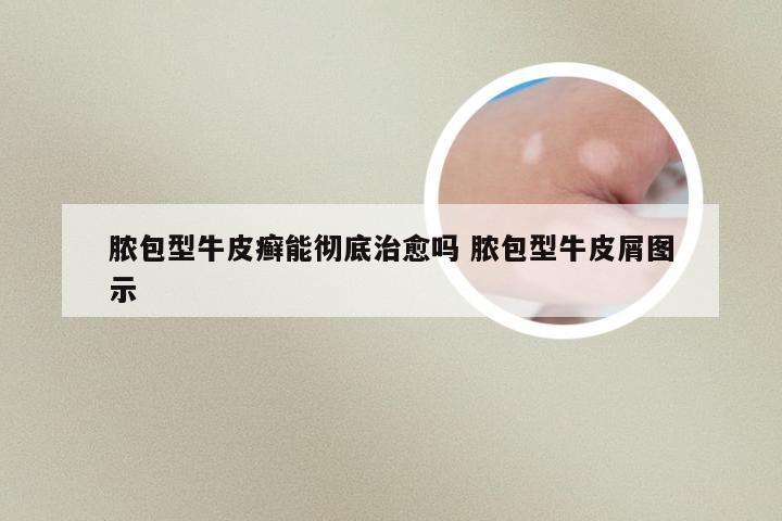 脓包型牛皮癣能彻底治愈吗 脓包型牛皮屑图示