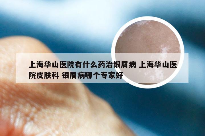 上海华山医院有什么药治银屑病 上海华山医院皮肤科 银屑病哪个专家好