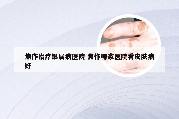 焦作治疗银屑病医院 焦作哪家医院看皮肤病好