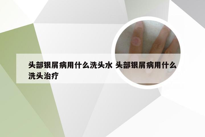 头部银屑病用什么洗头水 头部银屑病用什么洗头治疗