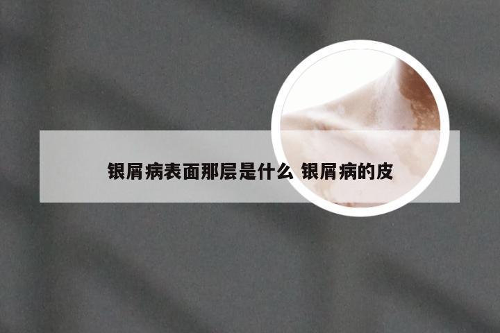 银屑病表面那层是什么 银屑病的皮