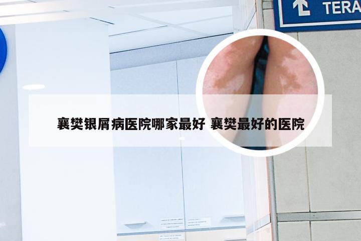 襄樊银屑病医院哪家最好 襄樊最好的医院