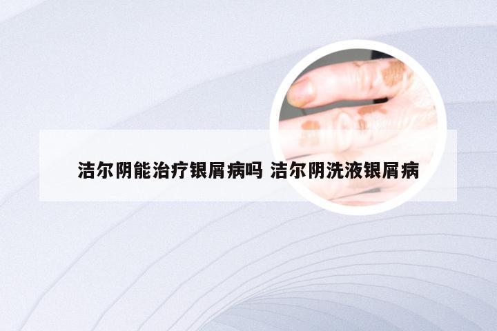 洁尔阴能治疗银屑病吗 洁尔阴洗液银屑病