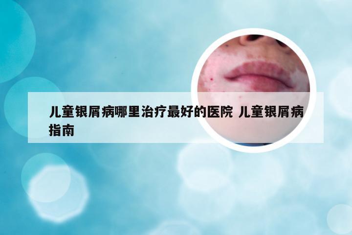 儿童银屑病哪里治疗最好的医院 儿童银屑病指南