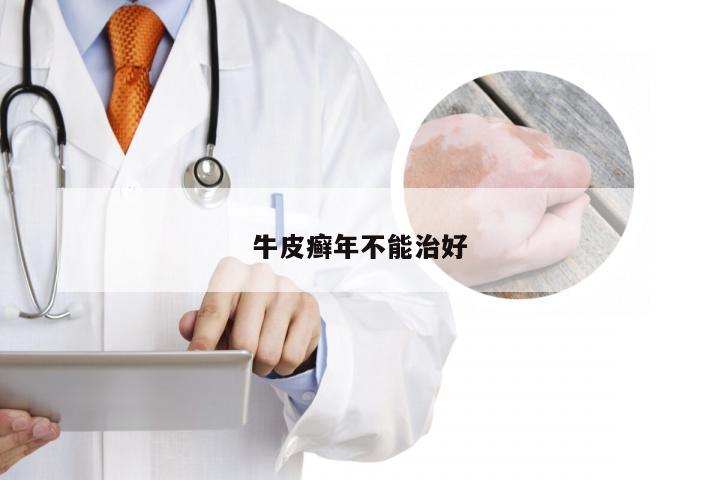 牛皮癣年不能治好