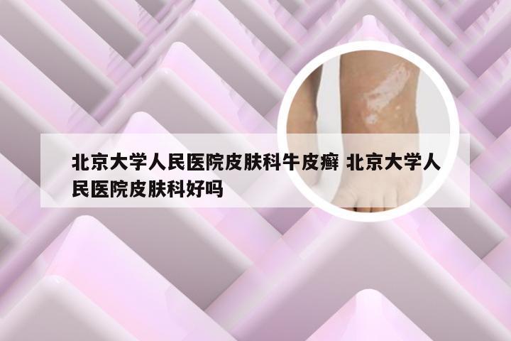 北京大学人民医院皮肤科牛皮癣 北京大学人民医院皮肤科好吗