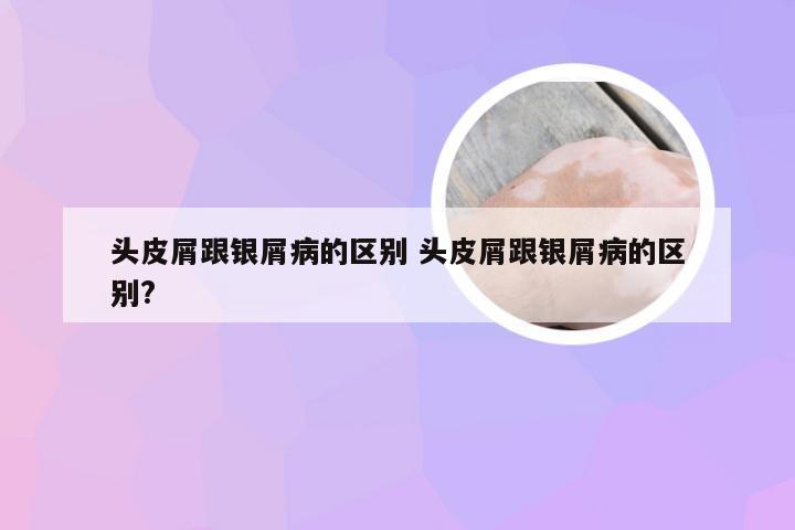 头皮屑跟银屑病的区别 头皮屑跟银屑病的区别?