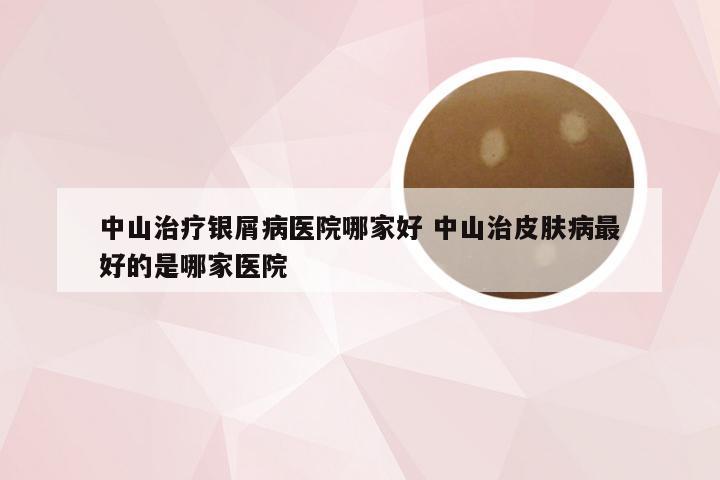 中山治疗银屑病医院哪家好 中山治皮肤病最好的是哪家医院