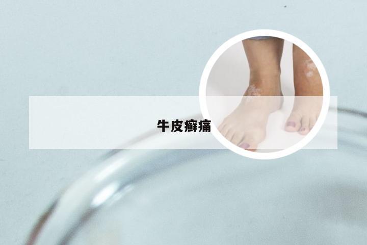 牛皮癣痛