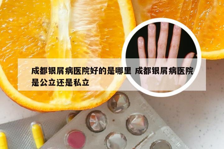成都银屑病医院好的是哪里 成都银屑病医院是公立还是私立