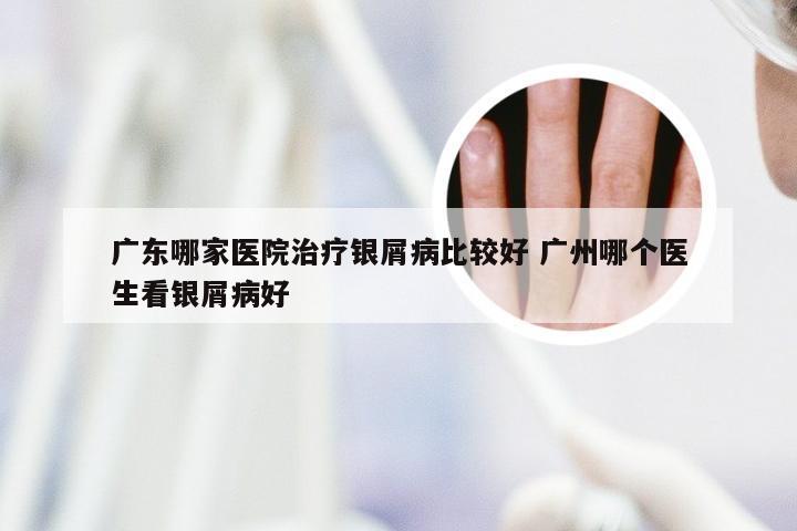 广东哪家医院治疗银屑病比较好 广州哪个医生看银屑病好