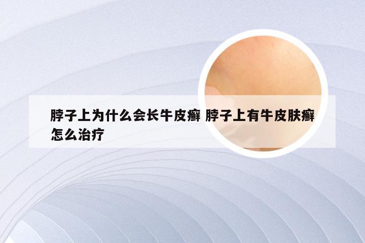 脖子上为什么会长牛皮癣 脖子上有牛皮肤癣怎么治疗