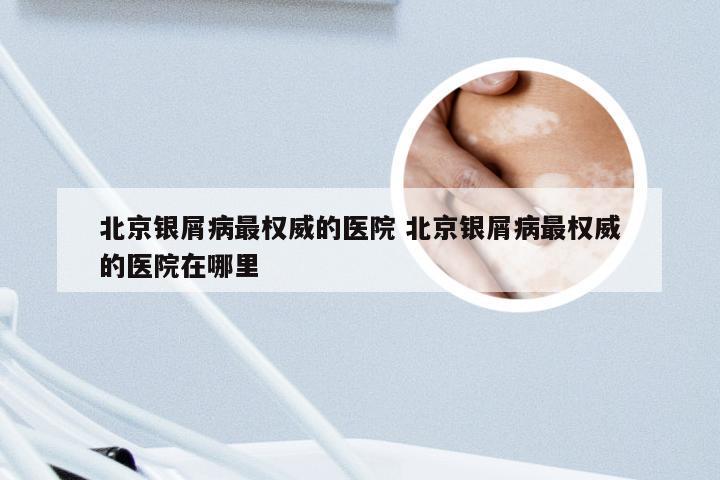 北京银屑病最权威的医院 北京银屑病最权威的医院在哪里