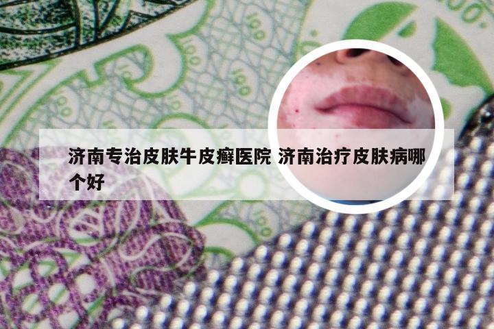 济南专治皮肤牛皮癣医院 济南治疗皮肤病哪个好